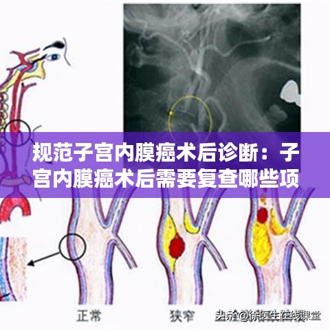 规范子宫内膜癌术后诊断：子宫内膜癌术后需要复查哪些项目 